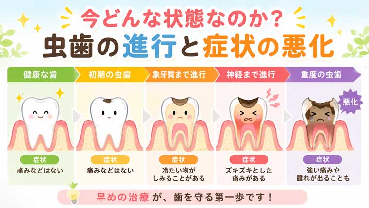 今どんな状態なのか？虫歯の進行と症状の悪化の図解