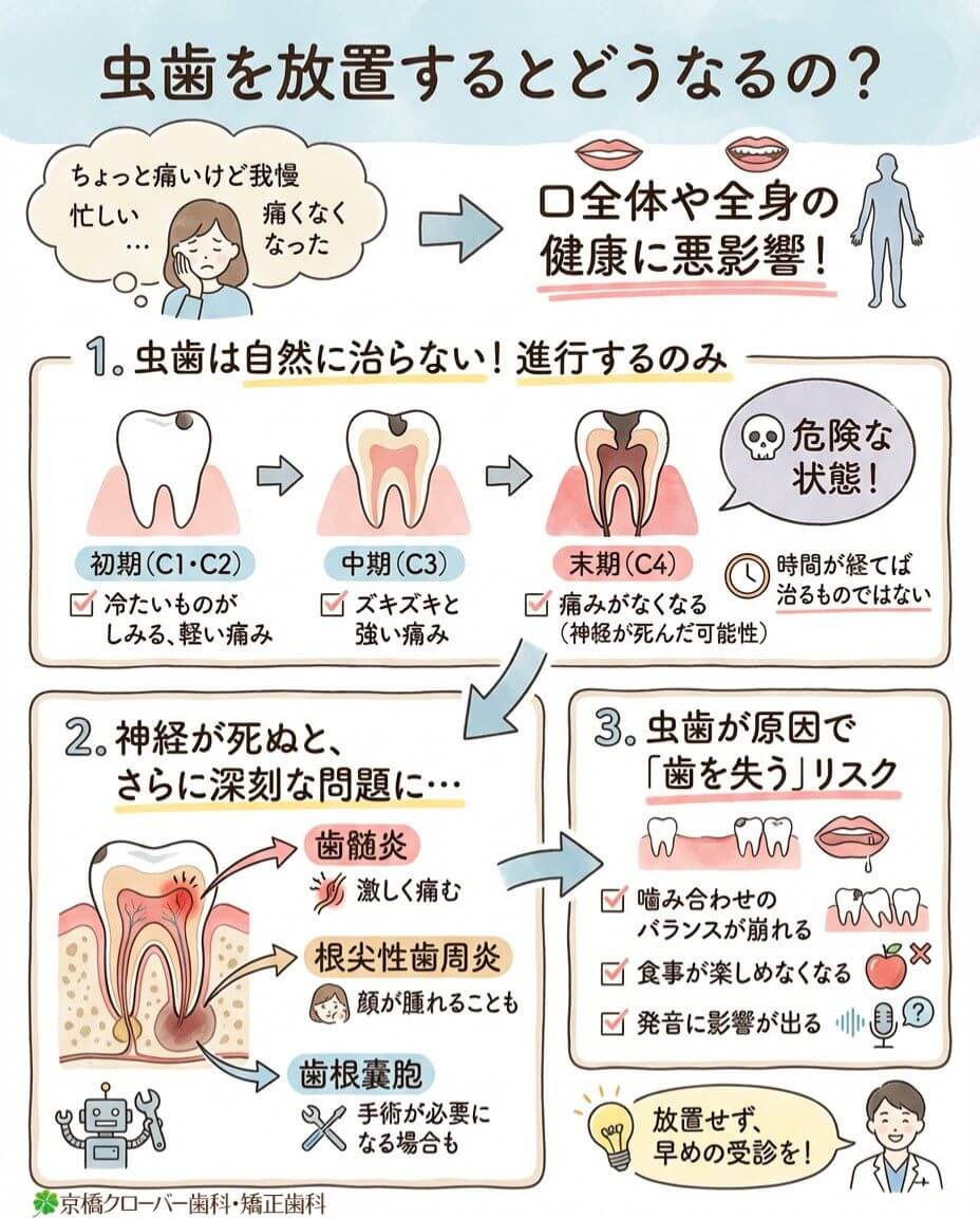虫歯を放置するとどうなるの？