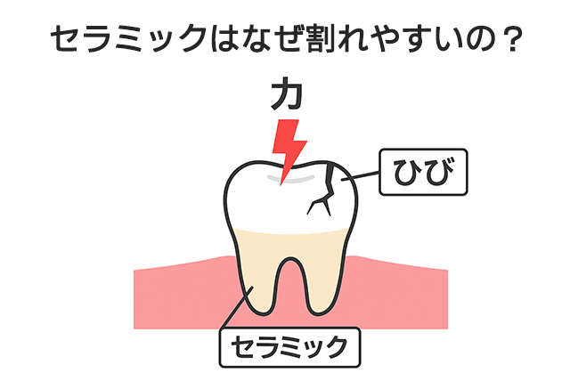 セラミックはなぜ割れやすいの?