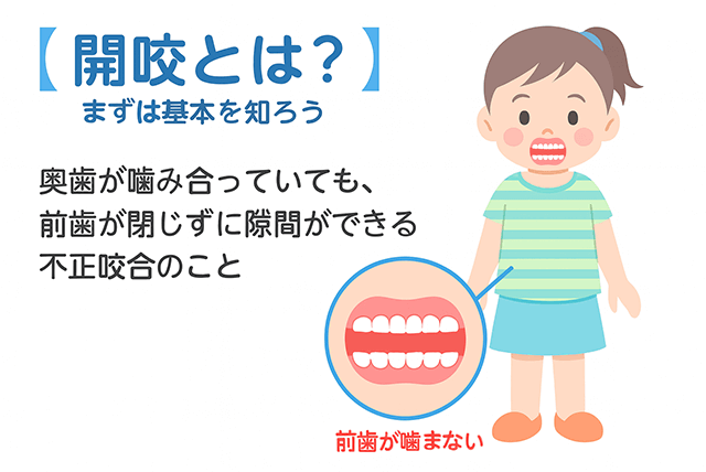 開咬とは？