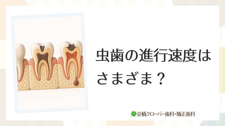 虫歯の進行速度はさまざま?