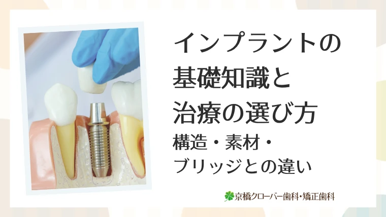 インプラントの基礎知識と治療の選び方｜構造・素材・ブリッジとの違い