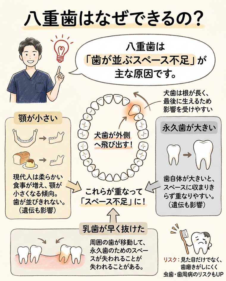 八重歯はなぜできるの？の図解