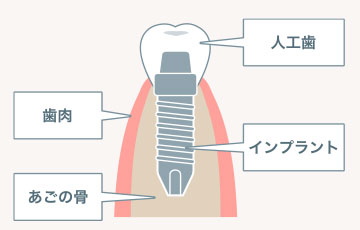 審美性・機能性に優れたインプラント