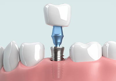 インプラント治療