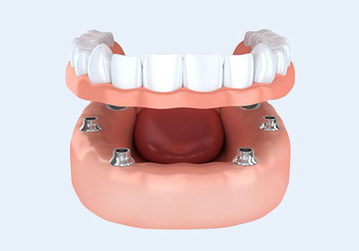 オーバーデンチャー