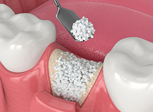 骨造成イメージ