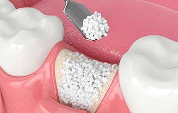 骨造成イメージ