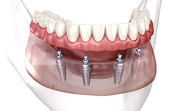 オールオン4のイメージ