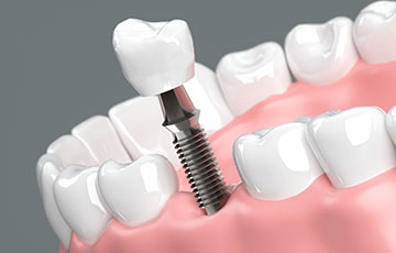 インプラントのイメージ