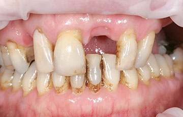 歯がボロボロの状態