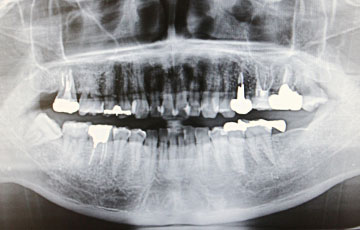 歯のレントゲン写真