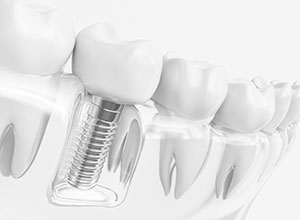 インプラントイメージ