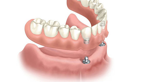 オーバーデンチャー