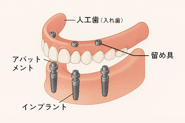 オーバーデンチャーのイメージ図