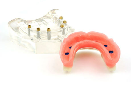 ロケーター義歯