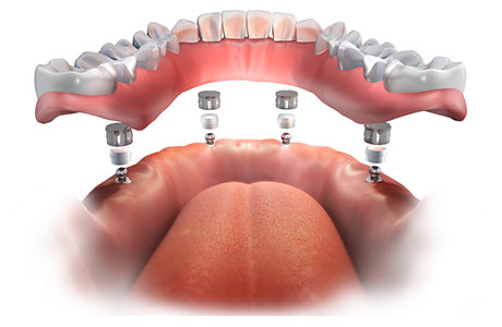 磁性アタッチメント