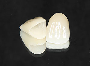 詰め物と被せ物