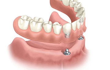オーバーデンチャー