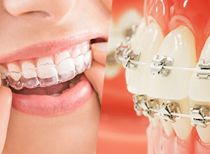 マウスピース矯正とワイヤー矯正
