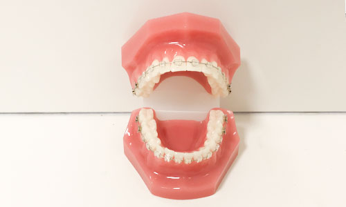 ワイヤー矯正の模型