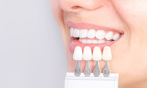 白くて綺麗な歯とシェードガイド