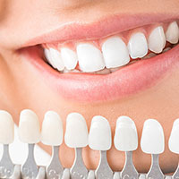 セラミック矯正