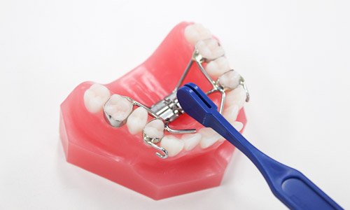 目立ちにくいワイヤー矯正