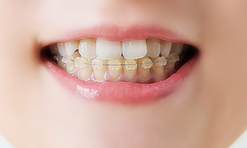 上下片顎のみ裏側も可能