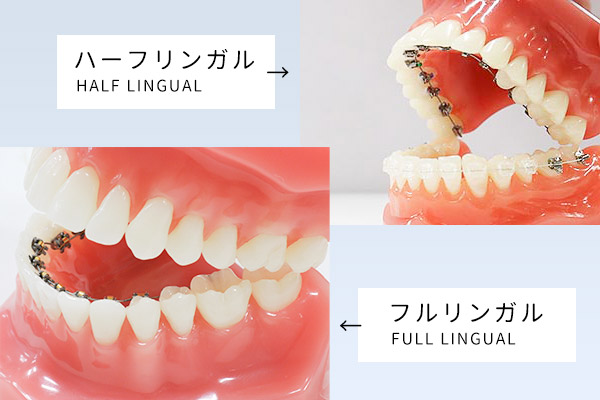 iTero（アイテロ）