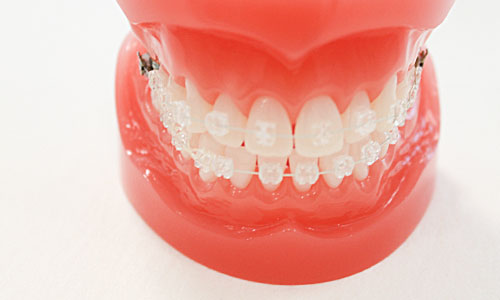 目立ちにくいワイヤー矯正