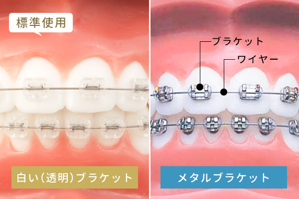矯正装置の比較