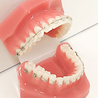 ワイヤー矯正/普通矯正